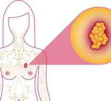 3 Stupnja raka dojke: očekivani životni vijek. Terapija raka dojke