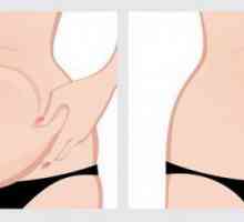 Abdominoplastika (abdominalna plastika): indikacije, kontraindikacije, opis postupka, recenzije