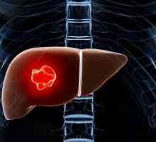 Adenoma jetre: uzroci, simptomi i karakteristike liječenja