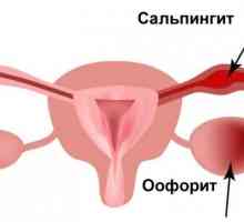 Adnexitis: simptomi i liječenje kod žena