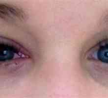 Alergija na ljepilo za proširenje trepavica: znakovi, liječenje, mjere opreza