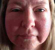 Alergija na lice na suncu: fotografije, simptomi, liječenje