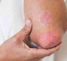 Alergija na žbuku: simptomi i liječenje