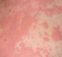 Alergija kod djece na papu: uzroci, simptomi i liječenje