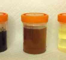 Analiza urina: Vrste i metode prikupljanja