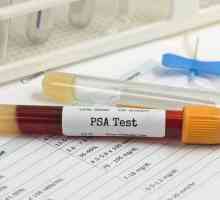 PSA analiza s prostatitisom: norma, svojstva pripreme i preporuke