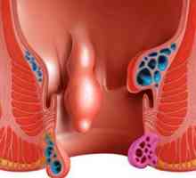 Analni polipi u anusu: simptomi i liječenje