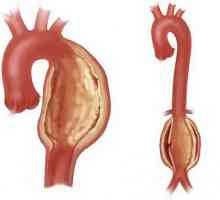 Aneurizma aorte srca - što je to? Aneurizma aorte: uzroci, simptomi, liječenje