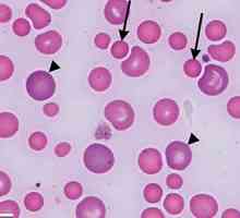 Anisocitoza eritrocita u općem testu krvi: pokazatelji