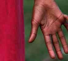 Anomalija razvoja grane: što učiniti ako dijete ima šest prstiju ili prste