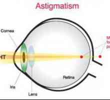 Astigmatske kontaktne leće: značajke, vrste i tehnologija korištenja