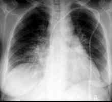 Atelektaza pluća: uzroci, dijagnoza, liječenje, vrijeme oporavka