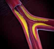 Ateroskleroza aorte srca - što je to? Simptomi i liječenje