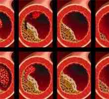 Ateroskleroza krvnih žila - simptomi, uzroci i liječenje