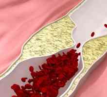 Stenoziranje ateroskleroze: simptomi i liječenje