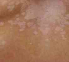 Bijele točke na koži nakon opeklina: liječenje, fotografija