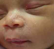 Bijele točkice na novorođenom nosu. Zašto novorođenčad ima bijelih točkica na nosu? Kada bijele…