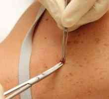 Biopsija kože: indikacije, postupak, rezultati