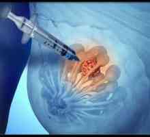 Biopsija dojki - što je to? Biopsija dojke: naznake za postupak i svojstva postupka