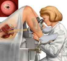 Biopsija cerviksa: što je to i zašto se taj postupak izvodi?