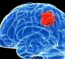 Blastoma mozga: simptomi, prognoza