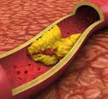 Plakovi u karotidnoj arteriji: liječenje. Kolesterolni plakovi: uzroci, simptomi