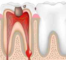 Je li bolno ukloniti živac iz zuba? Zašto zub treba živac? Kako ukloniti živac iz zuba
