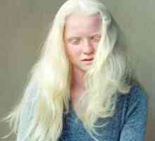 Albino čovječe. Ljudi `bez kože`