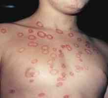 Koja je razlika između glatke kožne mikrosporije?
