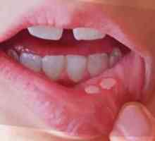 Što isprati usta s stomatitisom u kući?