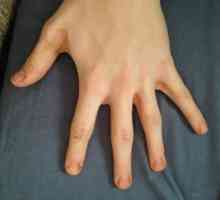 Cheshutya ruku između prstiju: uzroci i liječenje