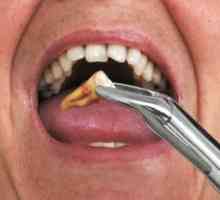 Što učiniti nakon ekstrakcije zuba - načine za zaustavljanje krvi i liječenje rane