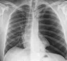 Što prikazuje X-ray? Kompetentno tumačenje rendgenskog zračenja pluća