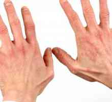 Što je dermatitis? Kako liječiti dermatitis?