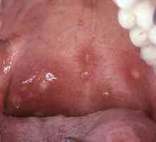 Što je herpes upala grla kod djece? Od liječenja infekcije?