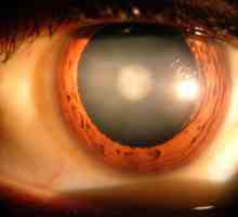 Što je lijeno oko i što je opasno?