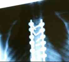 Što je X-zraka kralježnice?