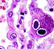 Cytomegalovirus infekcija: simptomi kod žena. Uzroci i metode liječenja CMV infekcije