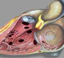 Poremećaj intervencijskog septuma. DMF za fetus: uzroci, dijagnoza i posljedice
