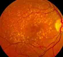 Degeneracija makularne retine: simptomi i liječenje