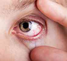 Demodetsko oči: uzroci, simptomi i značajke liječenja