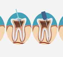 Depopulacija zuba: značajke postupka, indikacije