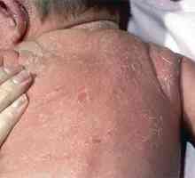 Exfoliativni dermatitis kod odraslih i novorođenčadi (fotografija)