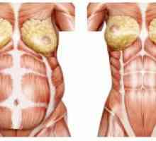 Diastaza rektuma abdominalnih mišića nakon poroda: znakovi, liječenje, fotografija