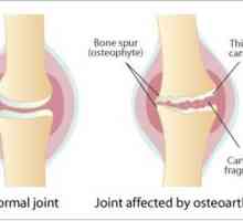 Dijeta za artroze zglobova koljena: preporuke