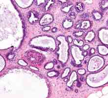 Difuznu fibro-adenomatozu mliječnih žlijezda: uzroci i liječenje
