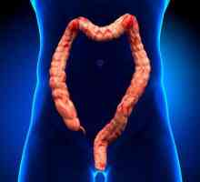 Dinamička opstrukcija crijeva: razvrstavanje, uzroci, simptomi i liječenje