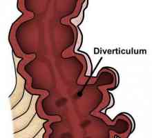 Divertikularna bolest debelog crijeva: simptomi i liječenje