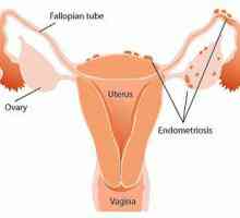 "Dyufaston" u endometriozi - recenzije. Učinkovitost "Dyufaston", cijena