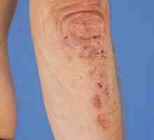 Diurin Dermatitis: uzroci, simptomi, dijagnoza i karakteristike liječenja